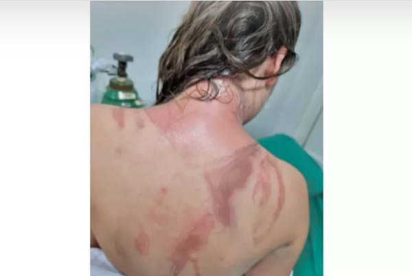 Universitários sofrem queimaduras durante aplicação de trote no Paraná