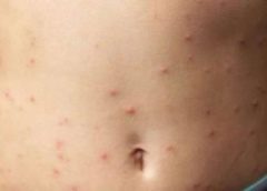 Paraná confirma mais 10 casos de sarampo e número chega a 944 no estado