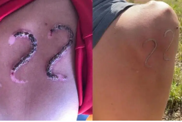 Jovem usa ferro de marcar gado para ‘tatuar’ número 22 de Bolsonaro na própria pele