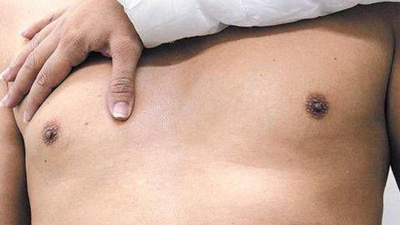 Ao menos 500 homens brasileiros desenvolvem câncer de mama ao ano