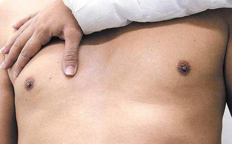 Ao menos 500 homens brasileiros desenvolvem câncer de mama ao ano
