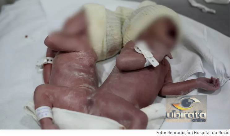 Gêmeos siameses nascem em parto raríssimo no Paraná