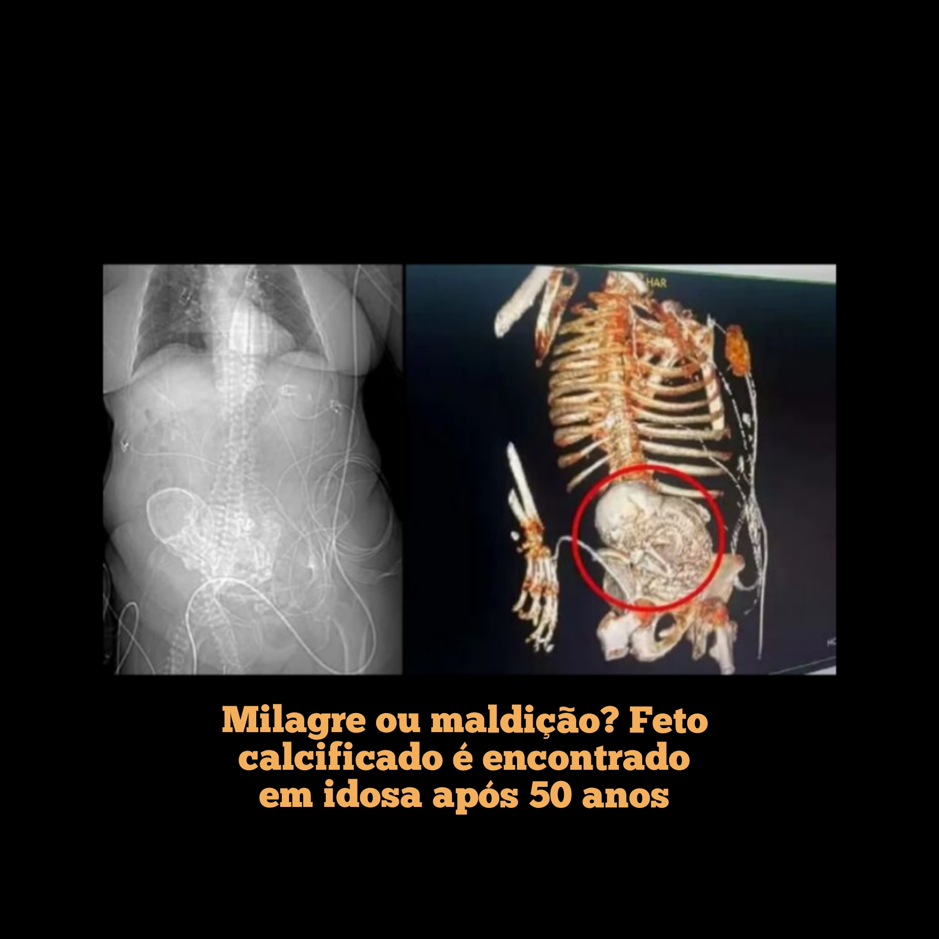 Milagre ou maldição? Feto calcificado é encontrado em idosa após 50 anos