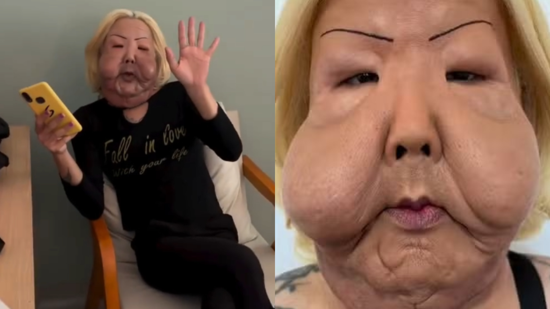 Juju do Pix reaparece nas redes e mostra evolução após cirurgia para retirada de óleo industrial do rosto; assista