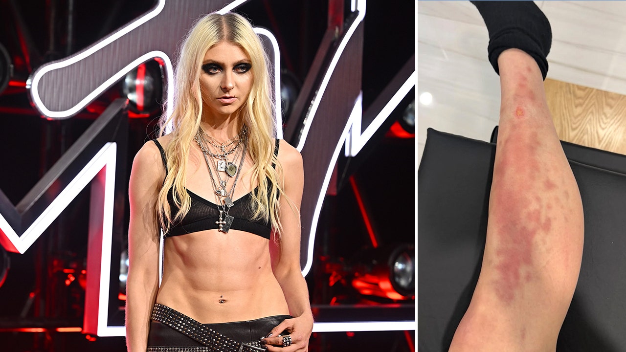 Taylor Momsen hospitalized after venomous spider bite on Mexico tour